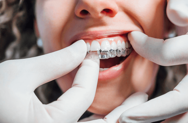 Ortodoncia invisible en zaragoza