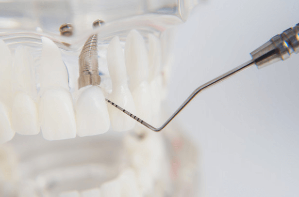 implantes dentales Zaragoza